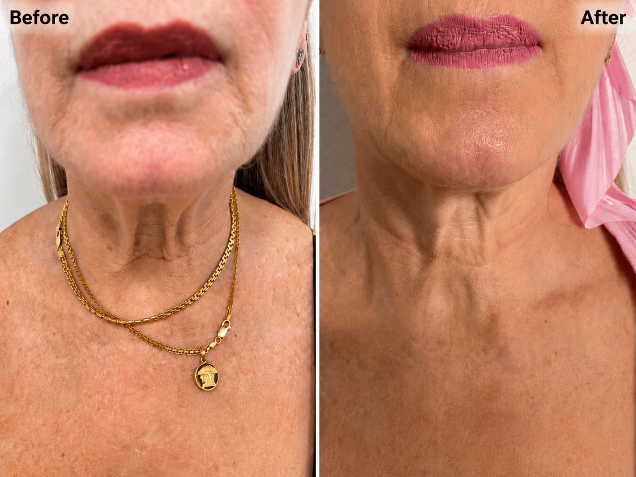Neck Tightening