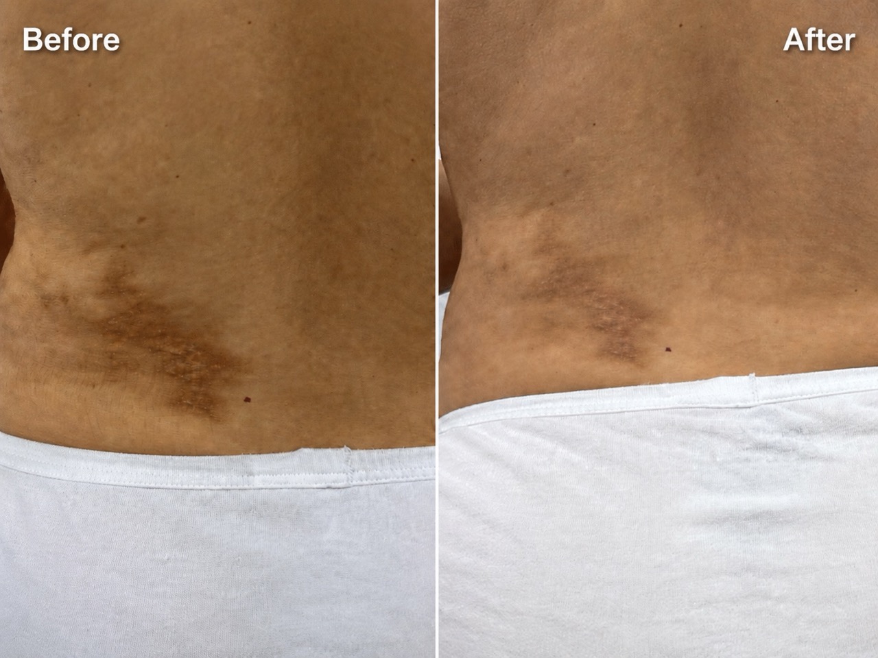 Scar treatment