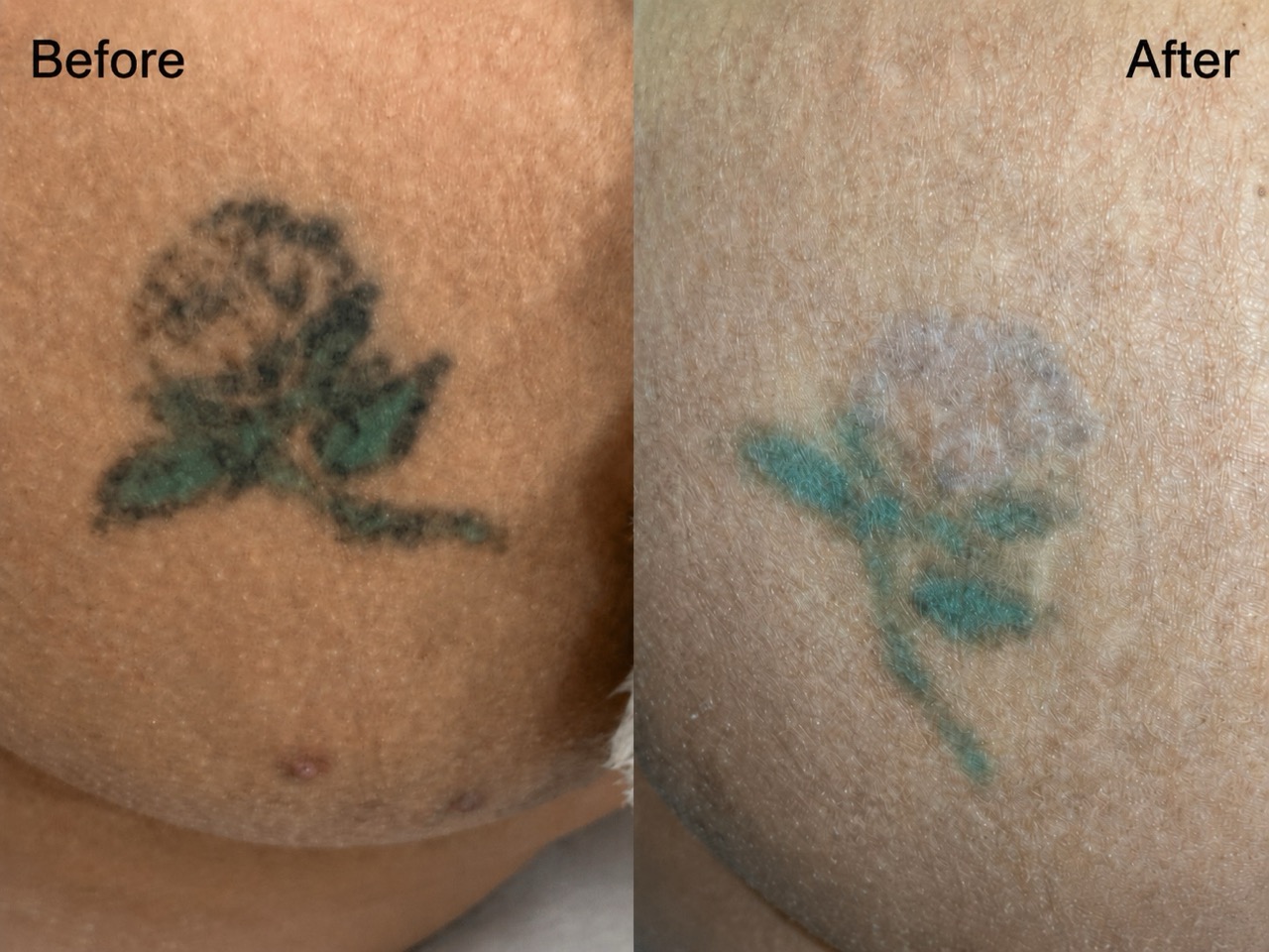 Tattoo removal